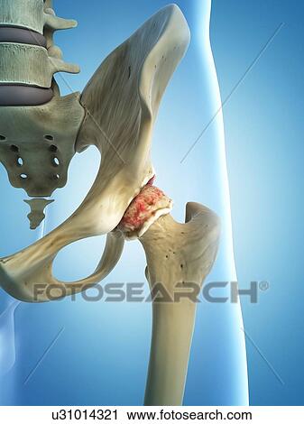 Clip Art - Arthritic hip, artwork. Fotosearch