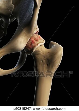 Arthritic hip, artwork View Large Illustration Stock Illustration - Arthritic hip, artwork. Fotosearch