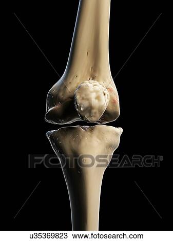 Arthritic knee, artwork View Large Illustration Drawing - Arthritic knee, artwork. Fotosearch