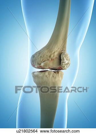 Arthritic knee, artwork View Large Illustration Stock Illustration - Arthritic knee, artwork. Fotosearch
