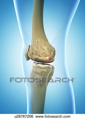 Stock Illustration - Arthritic knee, artwork. Fotosearch