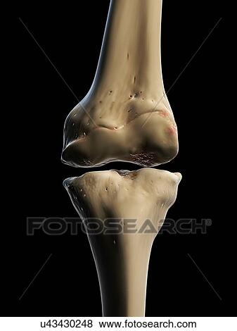 Arthritic knee, artwork View Large Illustration Stock Illustration - Arthritic knee, artwork. Fotosearch
