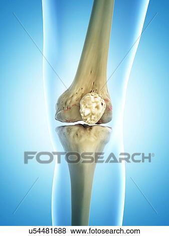 Arthritic knee, artwork View Large Illustration Stock Illustration - Arthritic knee, artwork. Fotosearch