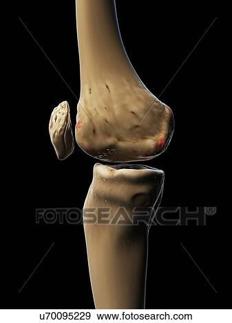 Stock Illustration - Arthritic knee, artwork. Fotosearch