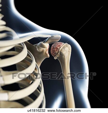Arthritic shoulder, artwork View Large Illustration Drawing - Arthritic shoulder, artwork. Fotosearch
