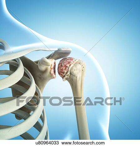 Arthritic shoulder, artwork View Large Illustration Drawing - Arthritic shoulder, artwork. Fotosearch