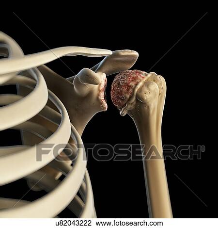 Arthritic shoulder, artwork View Large Illustration Drawing - Arthritic shoulder, artwork. Fotosearch