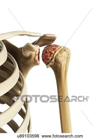 Arthritic shoulder, artwork View Large Illustration Stock Illustration - Arthritic shoulder, artwork. Fotosearch