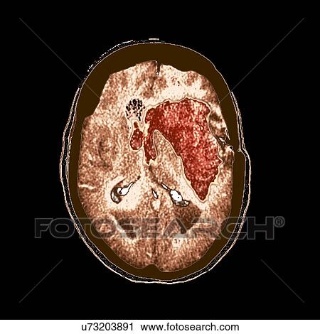 Clip Art - Brain haemorrhage, MRI scan. Fotosearch