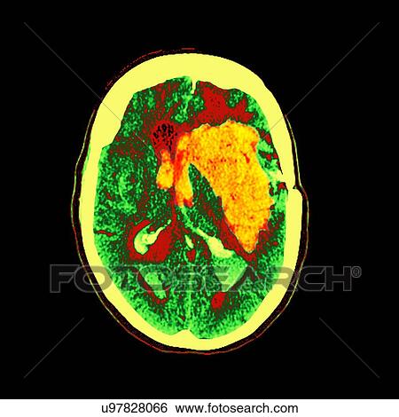 Stock Illustration - Brain haemorrhage, MRI scan. Fotosearch
