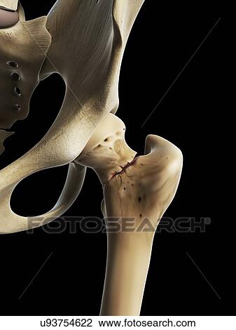 Drawing - Hip fracture, artwork. Fotosearch