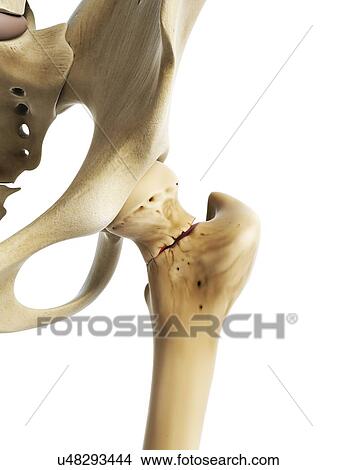 Hip fracture, artwork View Large Illustration Stock Illustration - Hip fracture, artwork. Fotosearch