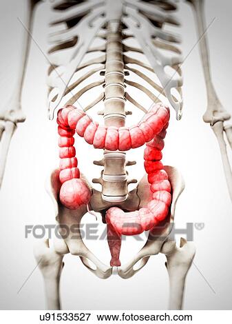 Stock Illustration - Inflamed colon, artwork. Fotosearch