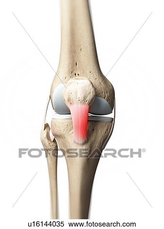 Inflamed patellar tendon, artwork View Large Illustration Stock Illustration - Inflamed patellar tendon, artwork. Fotosearch