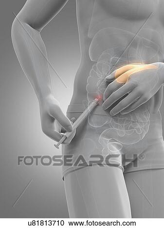 Insulin injection, artwork View Large Illustration Clipart - Insulin injection, artwork. Fotosearch