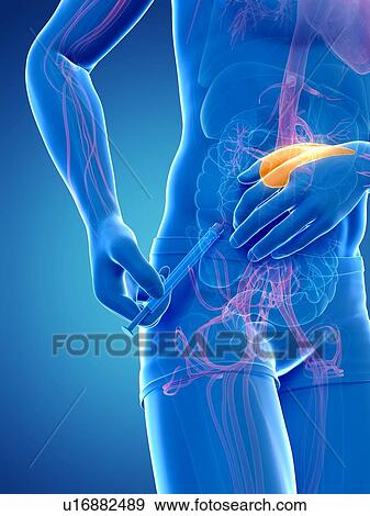 Insulin injection, artwork View Large Illustration Stock Illustration - Insulin injection, artwork. Fotosearch