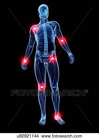 Joint pain, conceptual artwork View Large Illustration Stock Illustration - Joint pain, conceptual artwork. Fotosearch