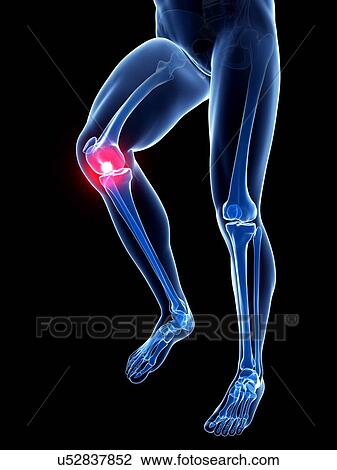 Knee pain, conceptual artwork View Large Illustration Drawing - Knee pain, conceptual artwork. Fotosearch