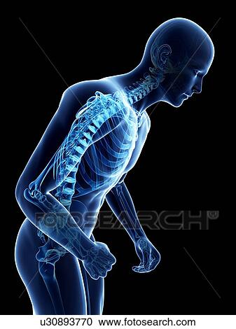 Parkinson's disease, conceptual artwork View Large Illustration Clipart - Parkinson's disease, conceptual artwork. Fotosearch