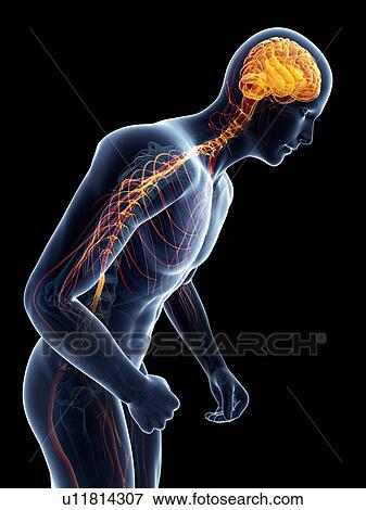 Parkinson's disease, conceptual artwork View Large Illustration Stock Illustration - Parkinson's disease, conceptual artwork. Fotosearch