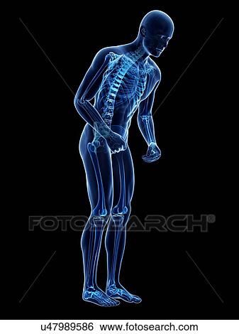 Parkinson's disease, conceptual artwork View Large Illustration Stock Illustration - Parkinson's disease, conceptual artwork. Fotosearch