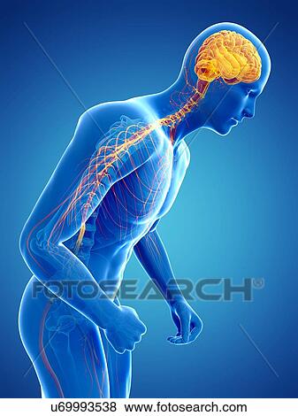 Parkinson's disease, conceptual artwork View Large Illustration Stock Illustration - Parkinson's disease, conceptual artwork. Fotosearch