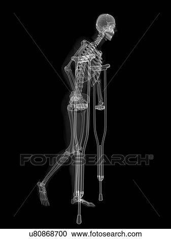 Clipart - Skeleton on crutches, artwork. Fotosearch