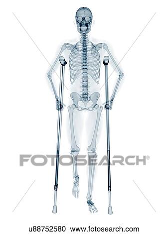Skeleton on crutches, artwork View Large Illustration Clipart - Skeleton on crutches, artwork. Fotosearch