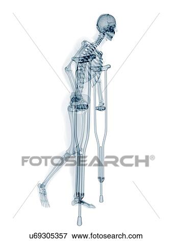 Skeleton on crutches, artwork View Large Illustration Stock Illustration - Skeleton on crutches, artwork. Fotosearch