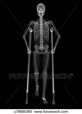 Stock Illustration - Skeleton on crutches, artwork. Fotosearch