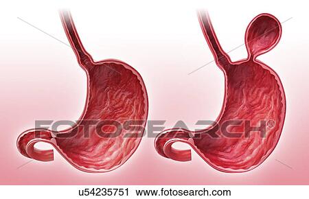 Clip Art - Human stomach with hernia, artwork. Fotosearch