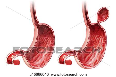 Clipart - Human stomach with hernia, artwork. Fotosearch