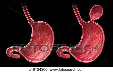 Human stomach with hernia, artwork View Large Illustration Clipart - Human stomach with hernia, artwork. Fotosearch