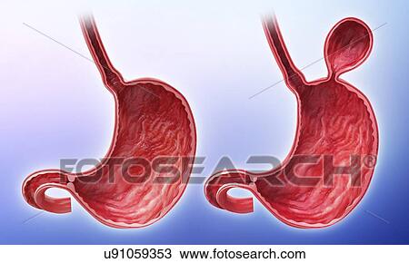 Drawing - Human stomach with hernia, artwork. Fotosearch