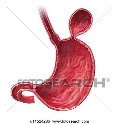 Human stomach with hernia, artwork Stock Illustration | u11524285 ...