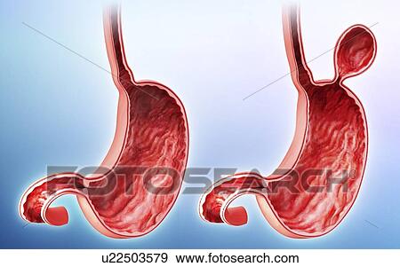 Stock Illustration - Human stomach with hernia, artwork. Fotosearch