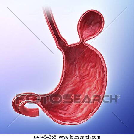 Stock Illustration - Human stomach with hernia, artwork. Fotosearch