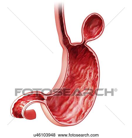 Stock Illustration - Human stomach with hernia, artwork. Fotosearch
