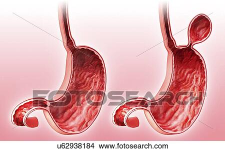 Stock Illustration - Human stomach with hernia, artwork. Fotosearch
