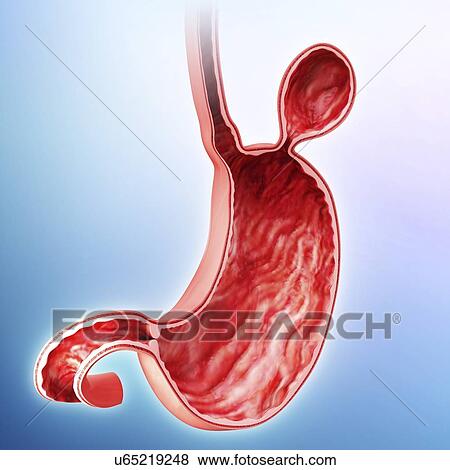 Stock Illustration - Human stomach with hernia, artwork. Fotosearch