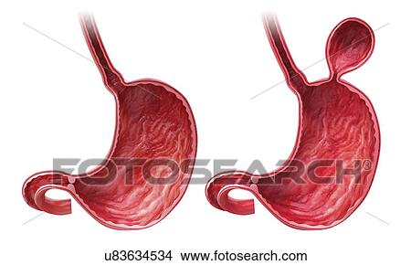 Human stomach with hernia, artwork View Large Illustration Stock Illustration - Human stomach with hernia, artwork. Fotosearch