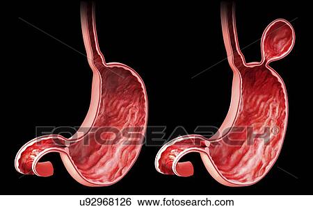 Human stomach with hernia, artwork View Large Illustration Stock Illustration - Human stomach with hernia, artwork. Fotosearch