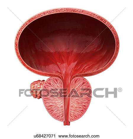 Clip Art - Prostate gland tumour, artwork. Fotosearch