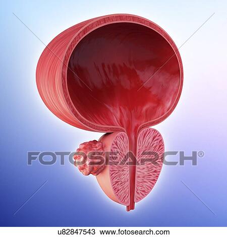 Drawing - Prostate gland tumour, artwork. Fotosearch