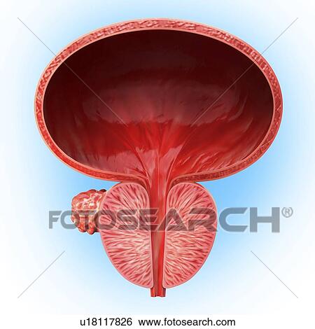 Stock Illustration - Prostate gland tumour, artwork. Fotosearch