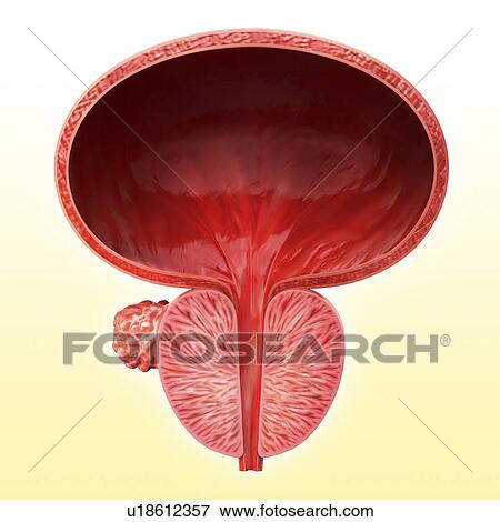 Stock Illustration - Prostate gland tumour, artwork. Fotosearch