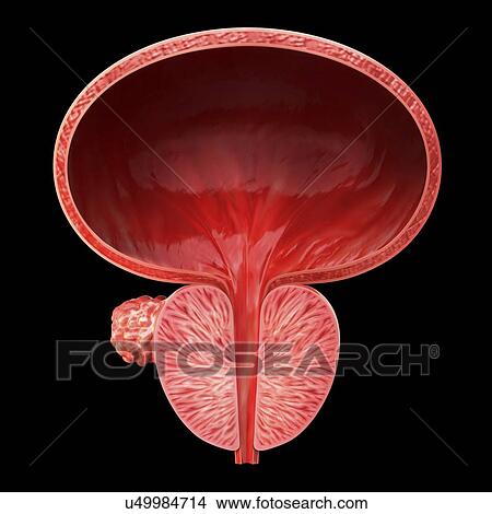 Stock Illustration - Prostate gland tumour, artwork. Fotosearch