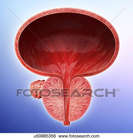 Stock Illustration - Prostate gland tumour, artwork. Fotosearch
