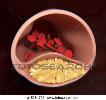 Atherosclerosis, artwork View Large Illustration Stock Illustration - Atherosclerosis, artwork. Fotosearch