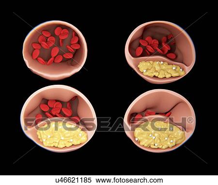 Stock Illustration - Atherosclerosis, artwork. Fotosearch